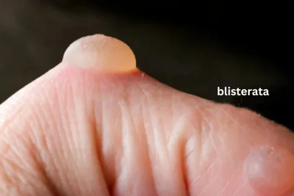 Blisterata: Unveiling the Ancient Art of Healing through Blisters